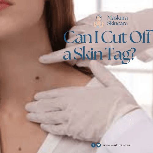 Can I Cut Off a Skin Tag? What You Need to Know Before You Do