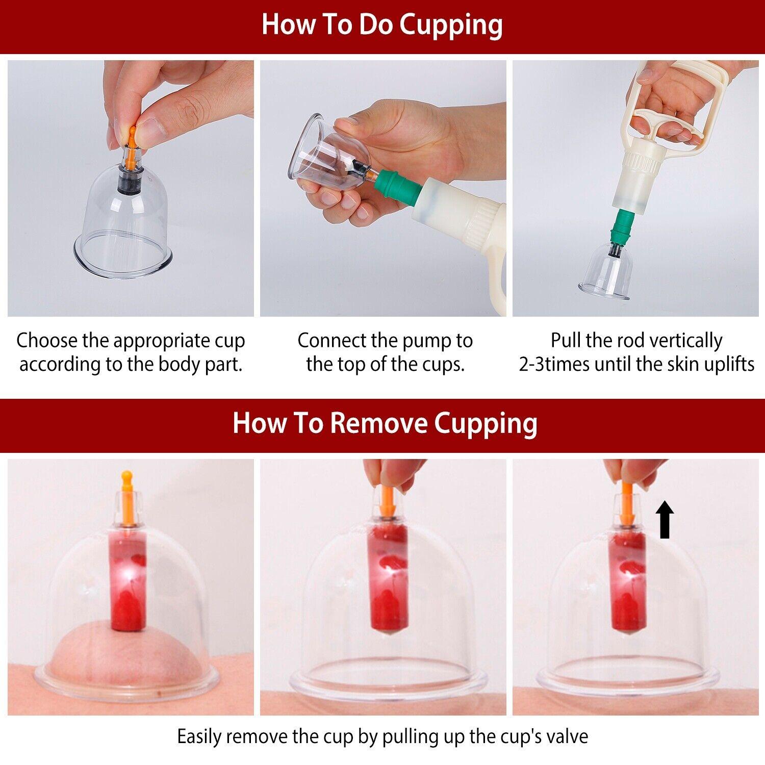 Cupping Therapy Sets