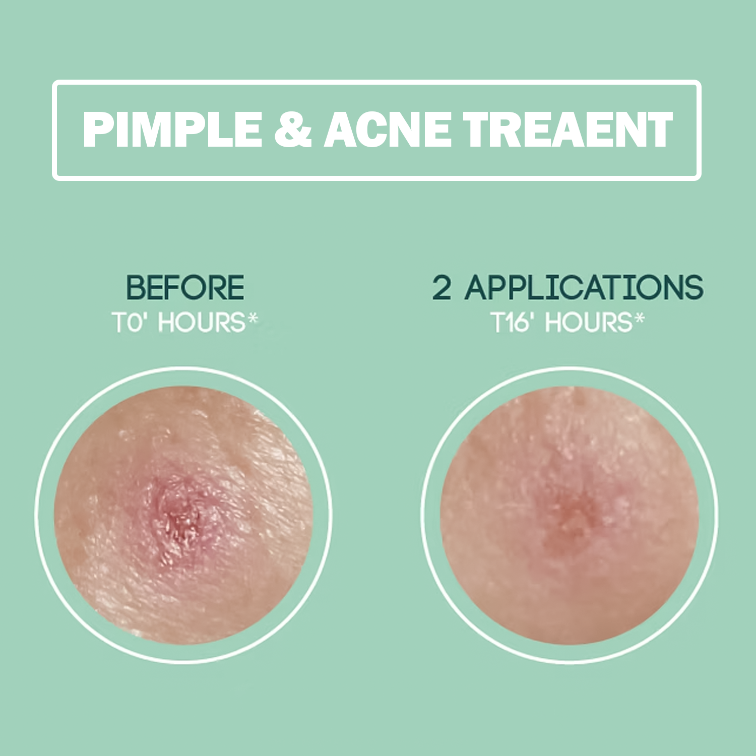 Acne spot patch for sensitive skin