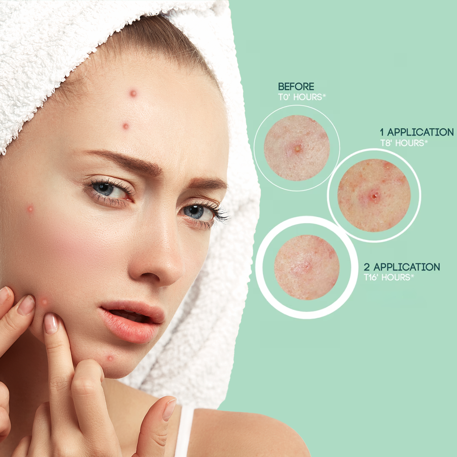Hydrocolloid pimple patches for acne treatment