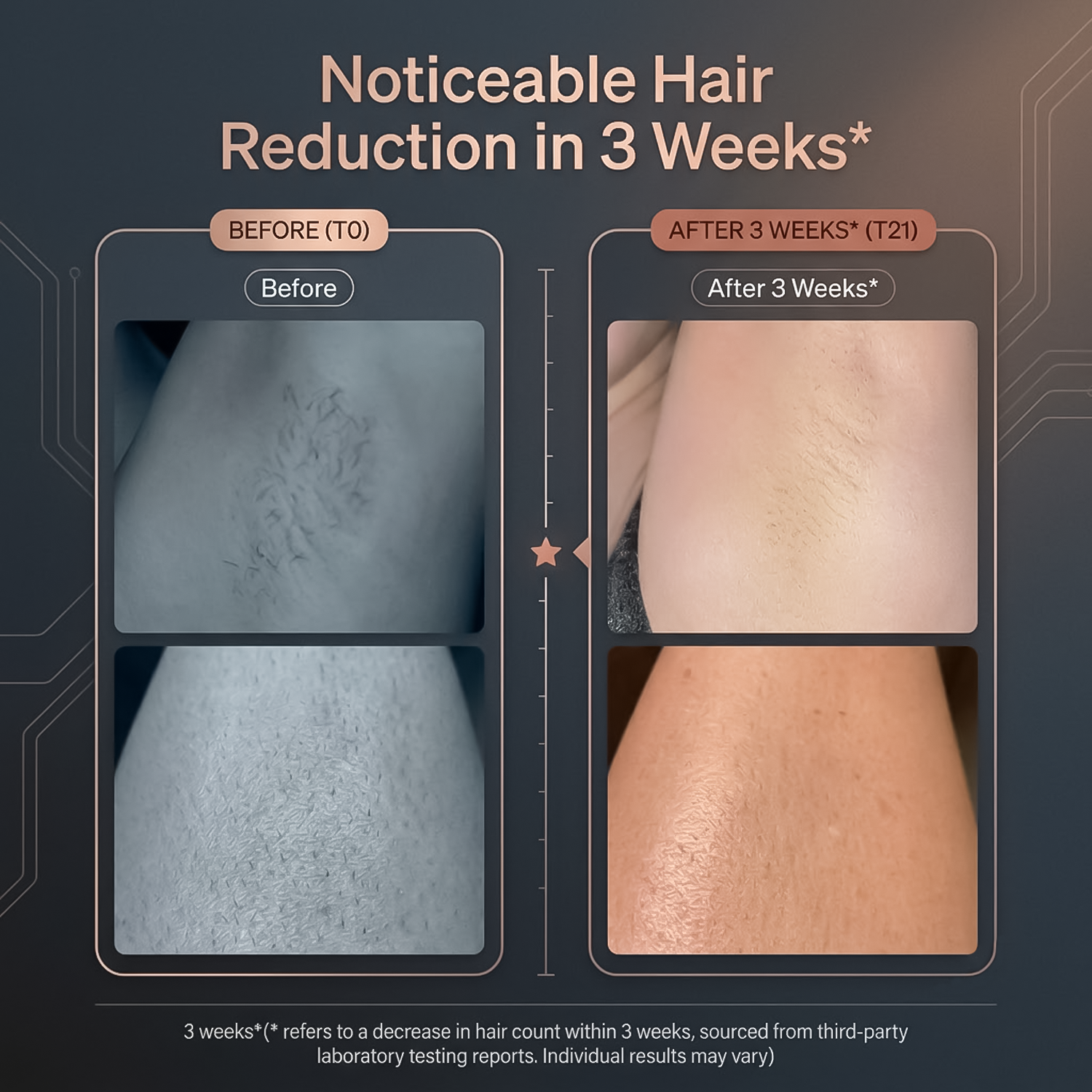 Permanent Hair Removal