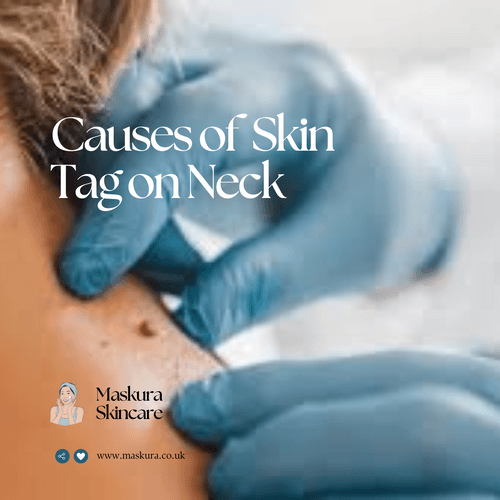 Cervical Tag Skin Tag on Neck