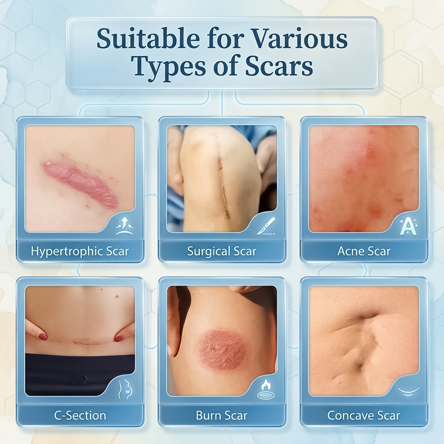 Silicone gel scar sheets for smoother skin appearance