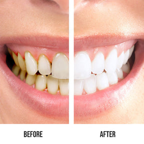 Led Light Teeth Whitening