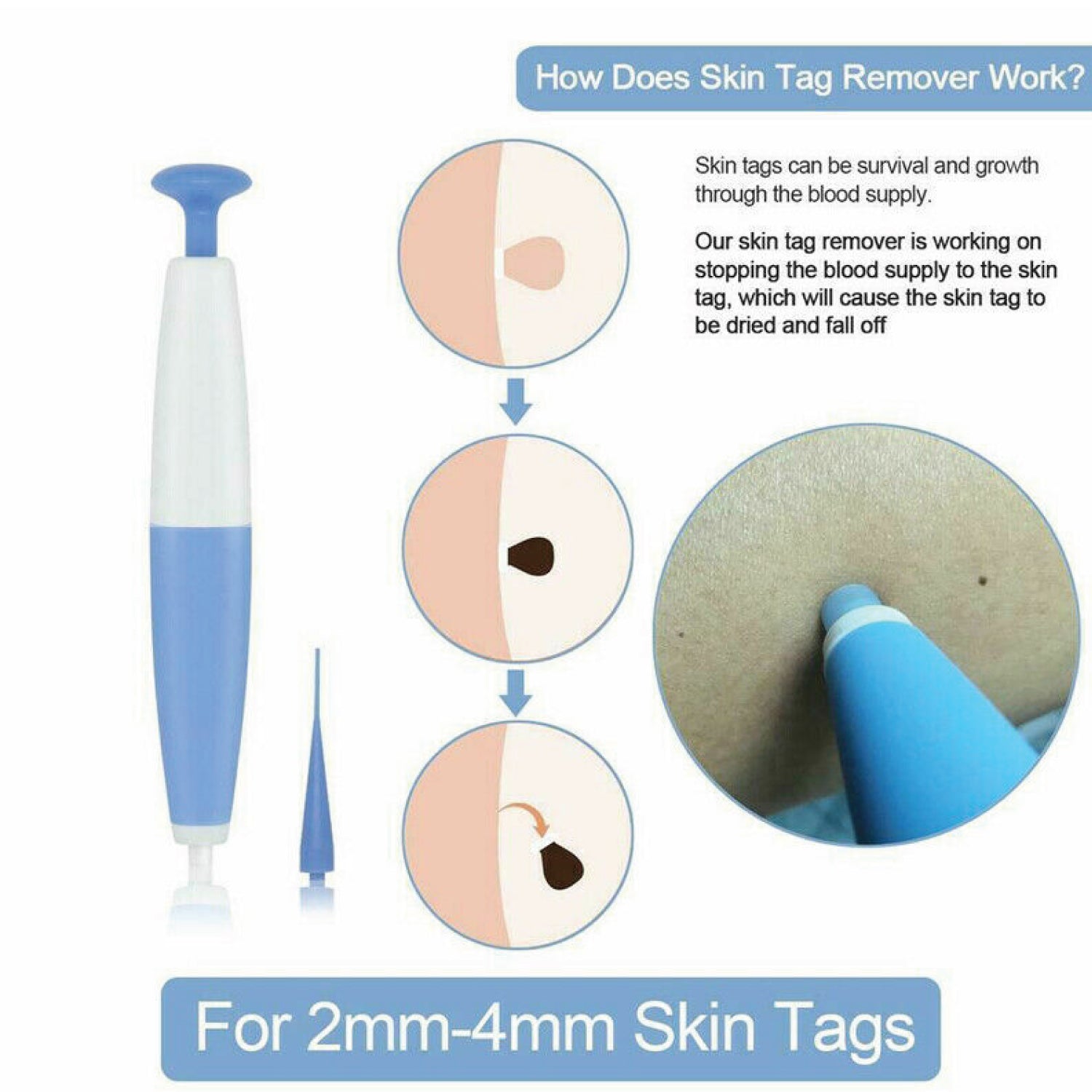 best skin tag remover