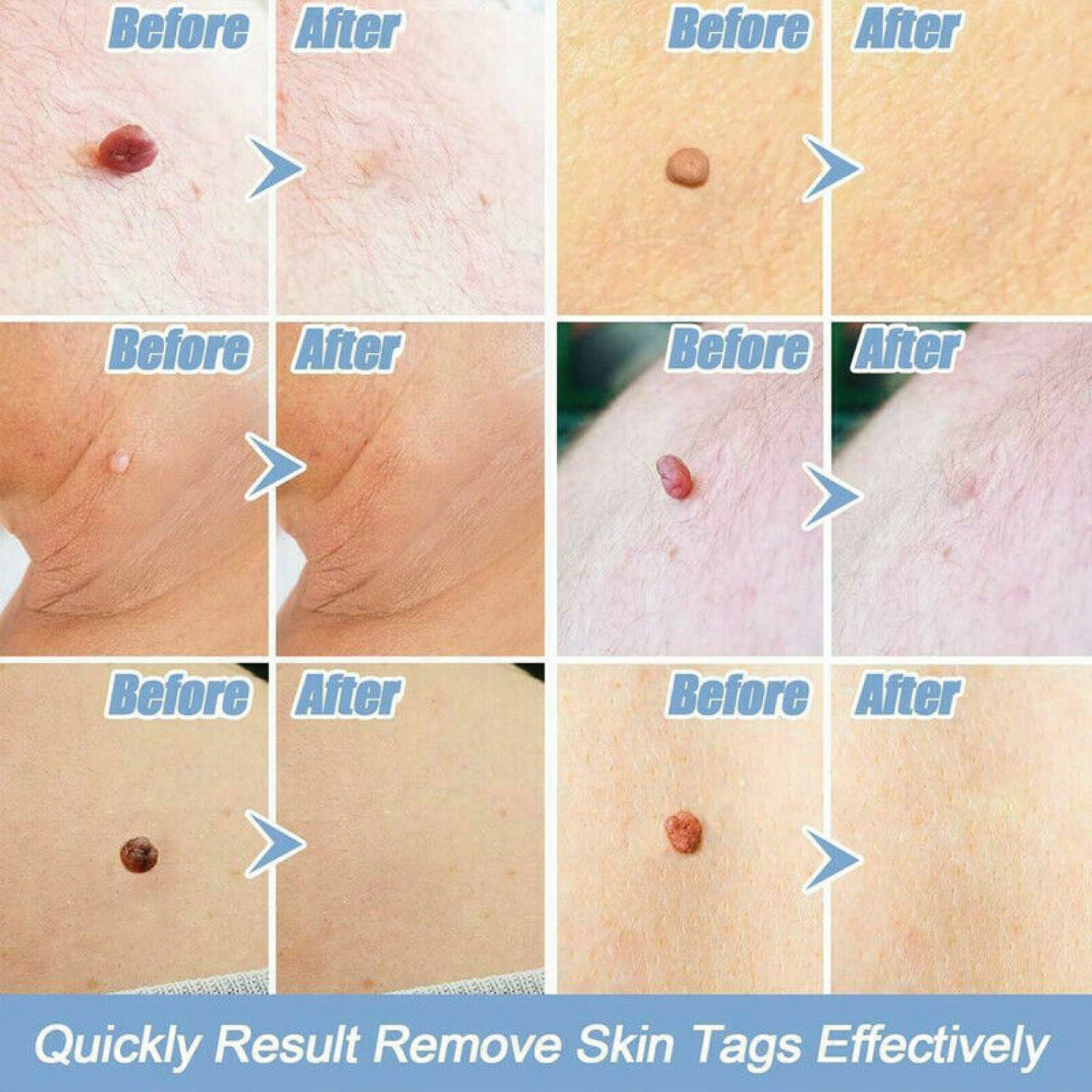 Skin Tag Removal Tool