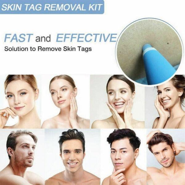 Remedy Skin Tag Remover